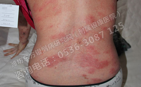 背部牛皮癣护理有没有什么可以方法呢