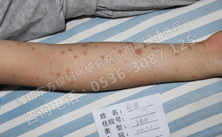 潍坊东方银屑病研究院解惑：人们为什么会长牛皮癣？