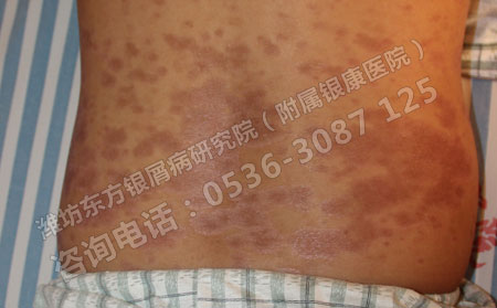 潍坊东方牛皮癣研究院提醒：牛皮癣的治疗别入误区