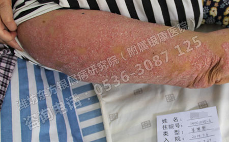 潍坊牛皮癣研究院答疑：老年人也会的牛皮癣吗？