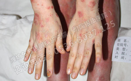 如何护理手部牛皮癣较有效？
