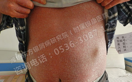 潍坊银屑病医院警告：牛皮癣治疗的误区患者切勿走入
