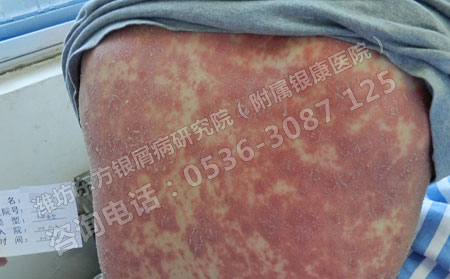 潍坊银屑病医院：治疗牛皮癣较有效的治疗方法是什么？