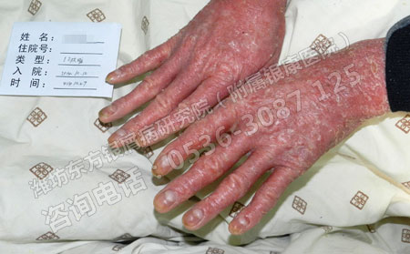 潍坊东方银屑病研究院：头部牛皮癣应该怎样护理？