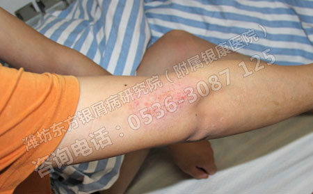 潍坊治疗牛皮癣较专业的医院是什么