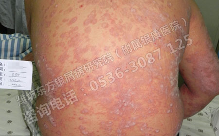 怀孕后牛皮癣复发怎么办