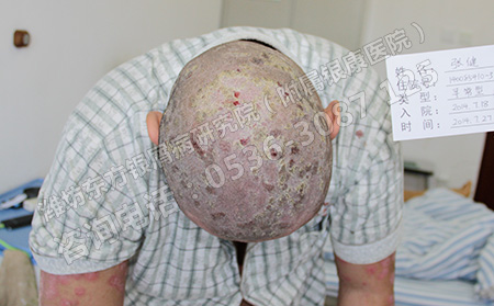 头部银屑病科学护理的四大关键