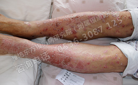 女性银屑病治疗需要注意的问题