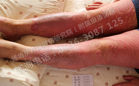 容易引起女性银屑病出现的四大原因