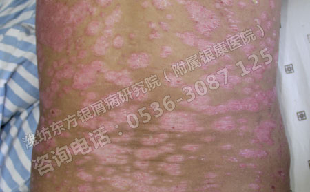 牛皮癣在治疗时怎样正确治疗才有效果