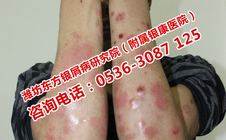 四肢牛皮癣扩散全身怎么治疗
