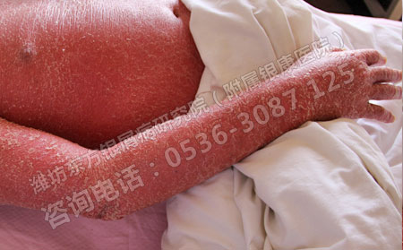 老年人得了牛皮癣会不会影响寿命