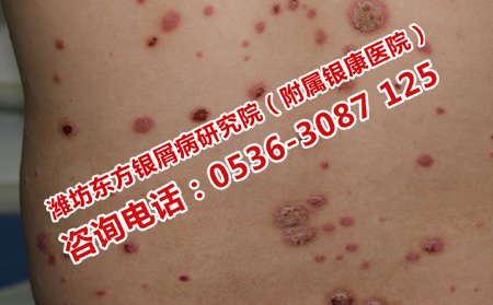 背部出现红疹子是不是牛皮癣呢