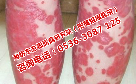 潍坊哪家医院可以治可以牛皮癣