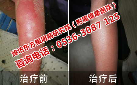 牛皮癣的治疗可以用大蒜吗