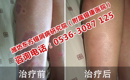 潍坊牛皮癣医院可以治可以牛皮癣吗