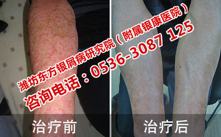 牛皮癣患者吃点什么可以