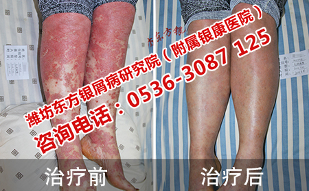 潍坊哪家医院治疗红皮型牛皮癣较有效