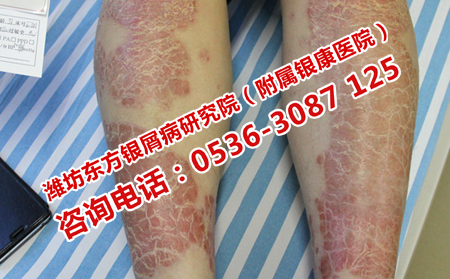 潍坊汽车站离潍坊牛皮癣医院近吗