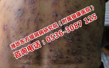 哪些项目有利于牛皮癣患者的运动
