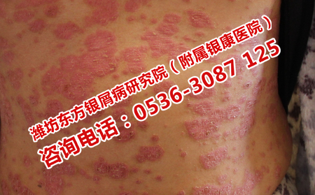 山东哪家医院治疗牛皮癣有效果