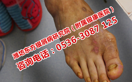 去潍坊牛皮癣医院治疗需要多少钱