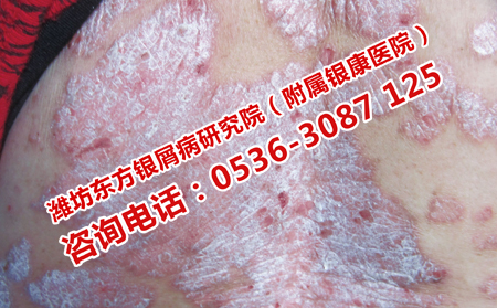 治疗牛皮癣哪家医院比较可以