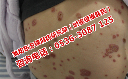 牛皮癣患者日常应该怎样护理肌肤