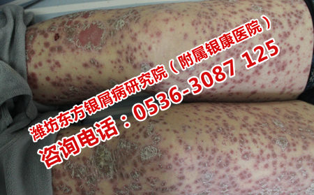 老年牛皮癣患者应该注意什么