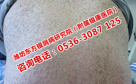 牛皮癣怎样护理较有效