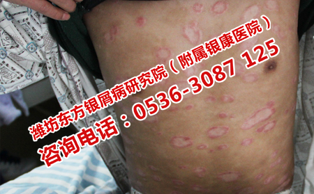 牛皮癣患者日常吃点什么可以