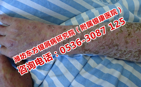 牛皮癣应该怎样护理