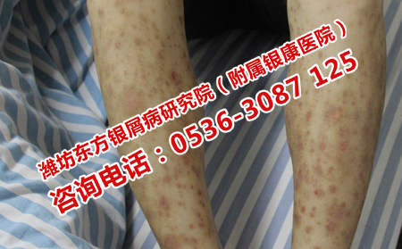 牛皮癣患者应该怎样护理