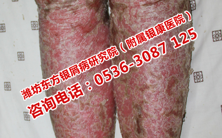 牛皮癣患者日常应该注意什么