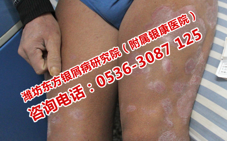 牛皮癣患者日常应该注意哪些问题