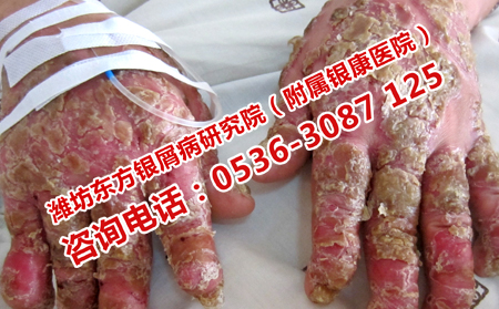 寻常型牛皮癣患者日常要注意哪些事情