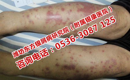 牛皮癣患者日常怎样护理较有效