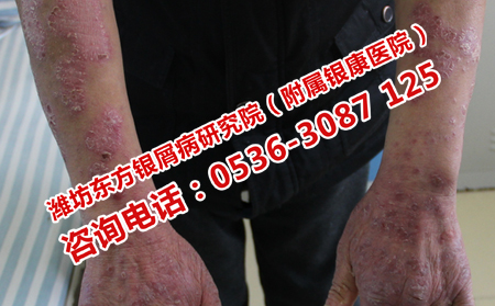 去哪儿能有效治疗牛皮癣