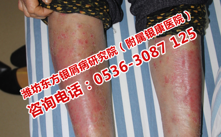 红皮型牛皮癣应该怎样护理