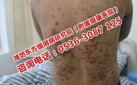 寻常型牛皮癣去哪儿治疗比较靠谱