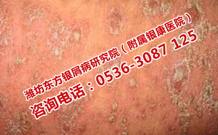 预防牛皮癣发病怎么办
