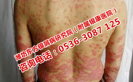 牛皮癣有治疗的必要吗