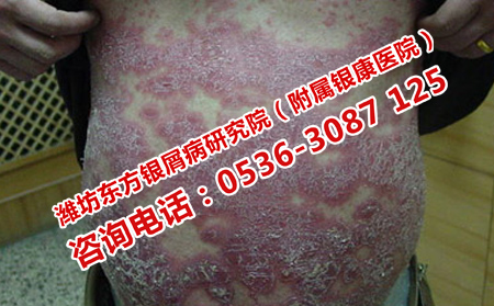 女性牛皮癣患者经期注意事项
