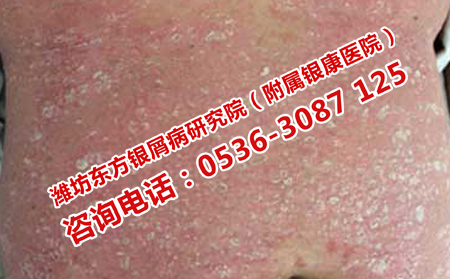 牛皮癣是怎么得的