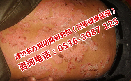 牛皮癣在不同发病时期应该如何进行治疗