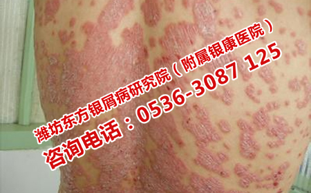 不同程度的牛皮癣要如何治疗