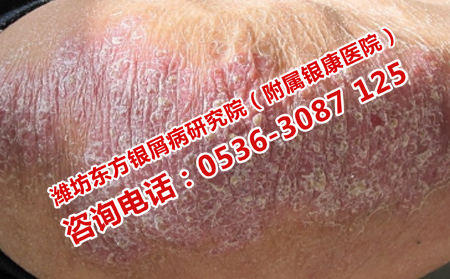 有关牛皮癣患者的饮食问题