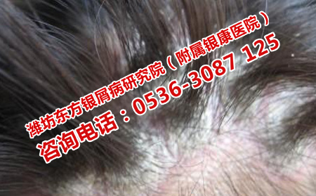 如何对头部银屑病进行可以的治疗