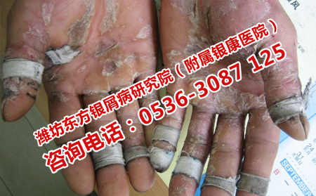 如何消除银屑病的瘙痒和脱屑