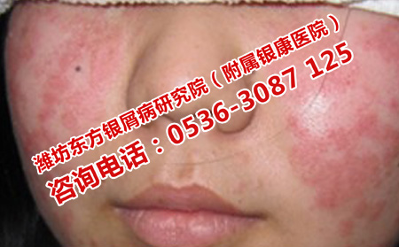 牛皮癣总是复发的原因是什么